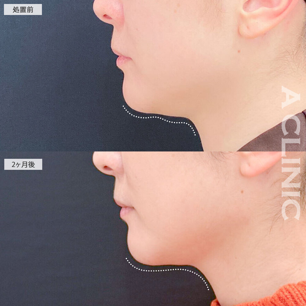 1day小顔脂肪吸引でアゴ下の脂肪が減り輪郭がクッキリ！こちら処置前と2ヶ月後の症例です(30代女性)