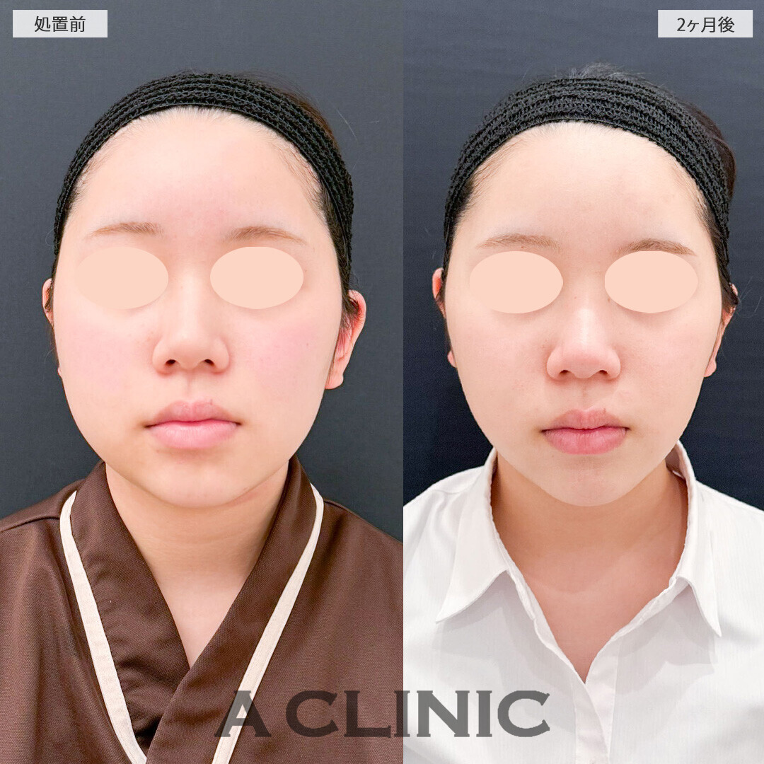 1day小顔脂肪吸引と小顔エラボトックスでスッキリしたフェイスラインに改善！処置前と2ヶ月後の症例です(10代女性)