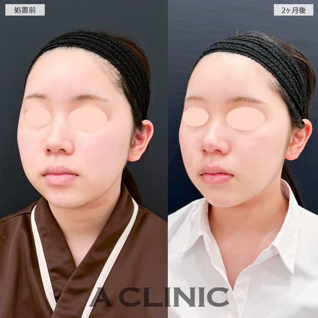 1day小顔脂肪吸引と小顔エラボトックスでスッキリしたフェイスラインに改善！処置前と2ヶ月後の症例です(10代女性)