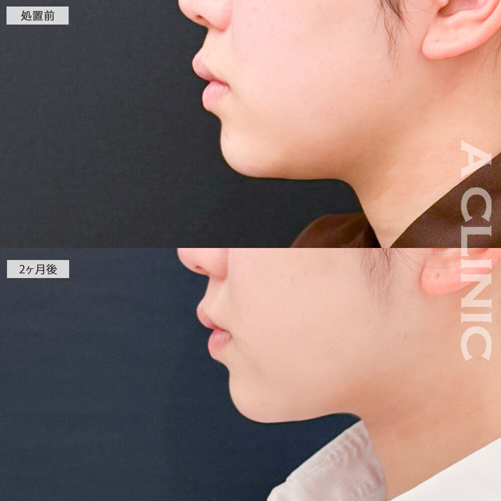 1day小顔脂肪吸引と小顔エラボトックスでスッキリしたフェイスラインに改善！処置前と2ヶ月後の症例です(10代女性)