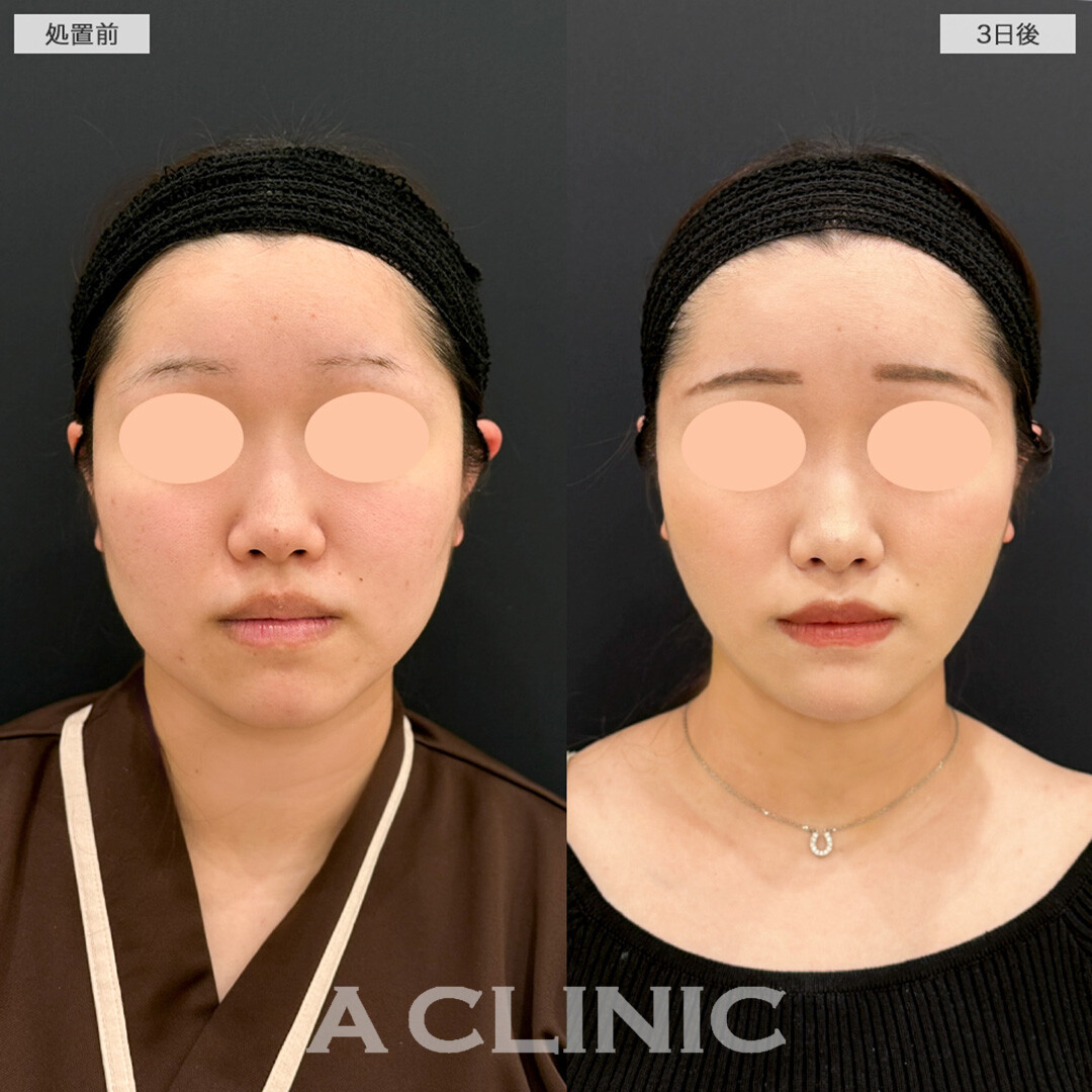 1day小顔脂肪吸引とあごへのヒアルロン酸注入で輪郭が綺麗に整う！こちら処置前と3日後の症例です(20代女性)