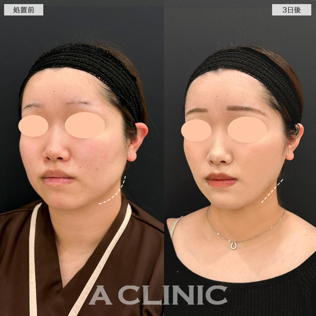 1day小顔脂肪吸引とあごへのヒアルロン酸注入で輪郭が綺麗に整う！こちら処置前と3日後の症例です(20代女性)