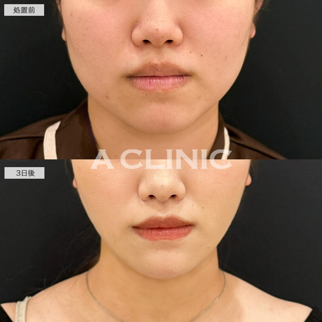 1day小顔脂肪吸引とあごへのヒアルロン酸注入で輪郭が綺麗に整う！こちら処置前と3日後の症例です(20代女性)