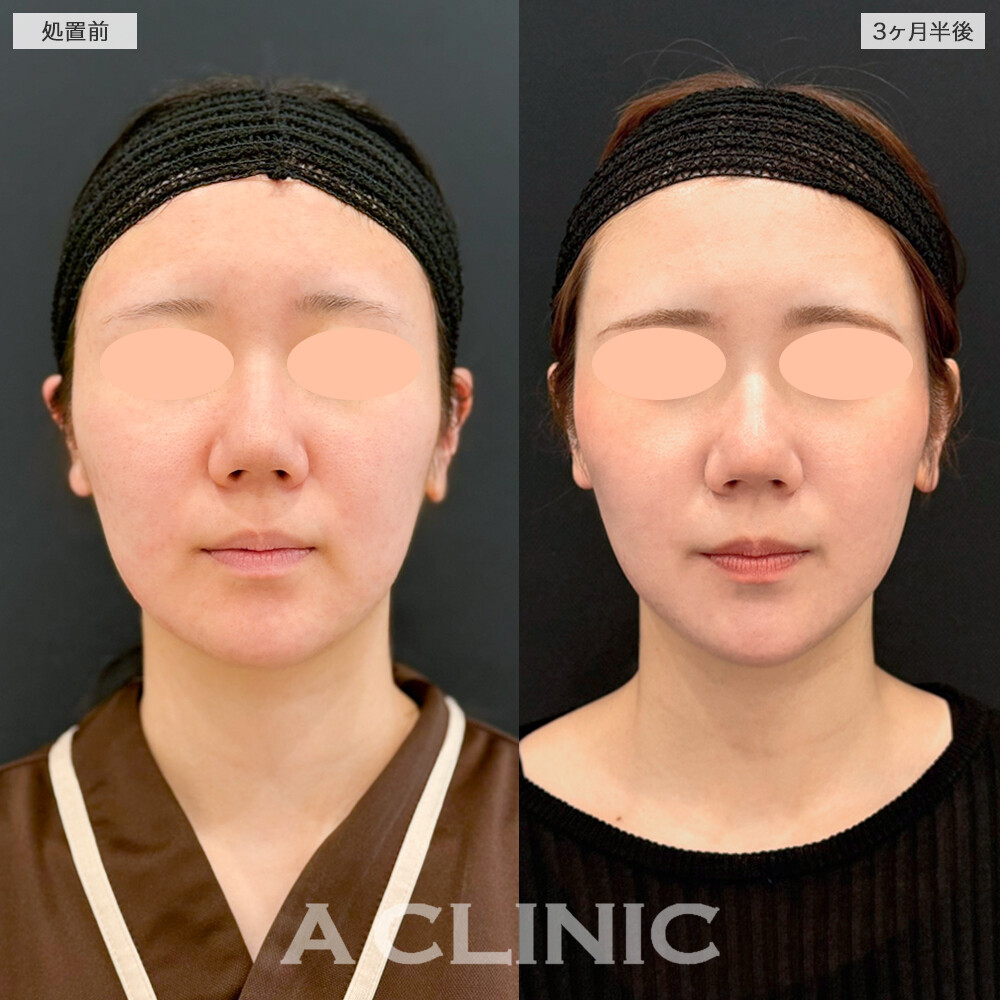 1day小顔脂肪吸引でお顔がひとまわり小さくなりました！処置前と3ヶ月半後の症例です(20代女性)