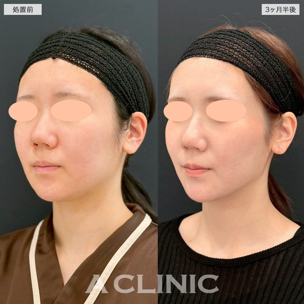 1day小顔脂肪吸引でお顔がひとまわり小さくなりました！処置前と3ヶ月半後の症例です(20代女性)