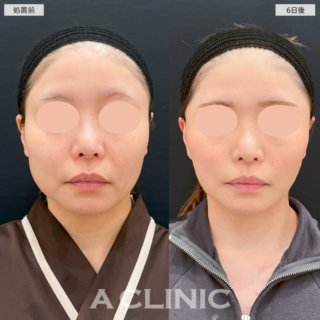 1day小顔脂肪吸引とA式たるみ切開で一人ひとりに合わせてお顔のバランスを整えることができます！処置前と6日後の症例です(30代女性)