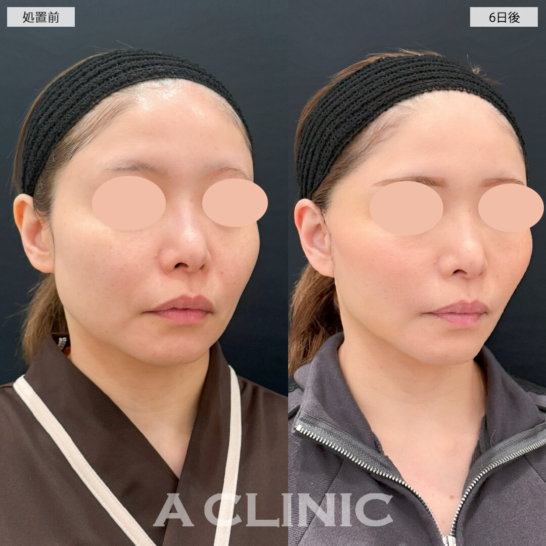 1day小顔脂肪吸引とA式たるみ切開で一人ひとりに合わせてお顔のバランスを整えることができます！処置前と6日後の症例です(30代女性)