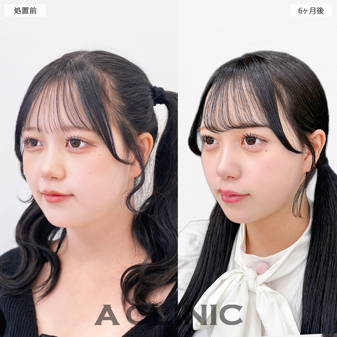 小顔になって圧倒的に可愛く垢抜けました！1day小顔脂肪吸引の処置前と6ヶ月後の症例です(10代女性)
