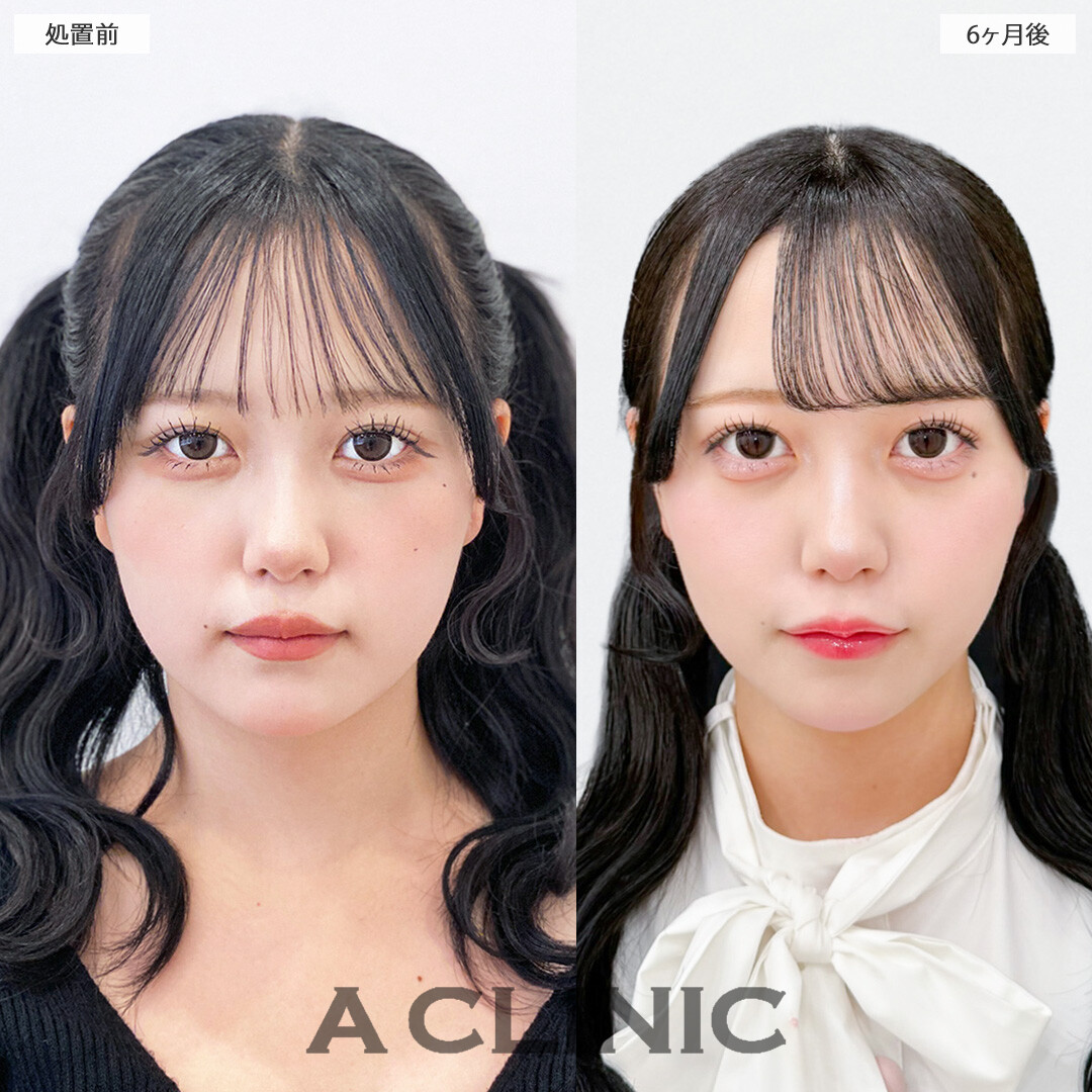 小顔になって圧倒的に可愛く垢抜けました！1day小顔脂肪吸引の処置前と6ヶ月後の症例です(10代女性)
