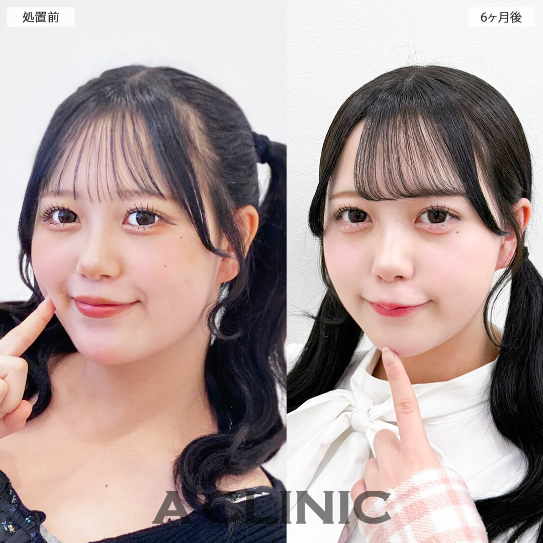 小顔になって圧倒的に可愛く垢抜けました！1day小顔脂肪吸引の処置前と6ヶ月後の症例です(10代女性)