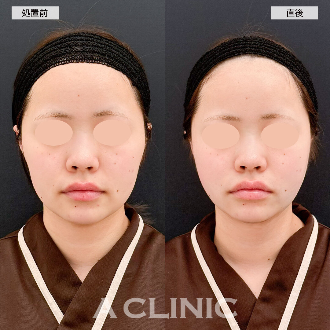 1day小顔脂肪吸引なら直後から腫れ無しで効果を実感できます！処置前と直後の症例です(20代女性)