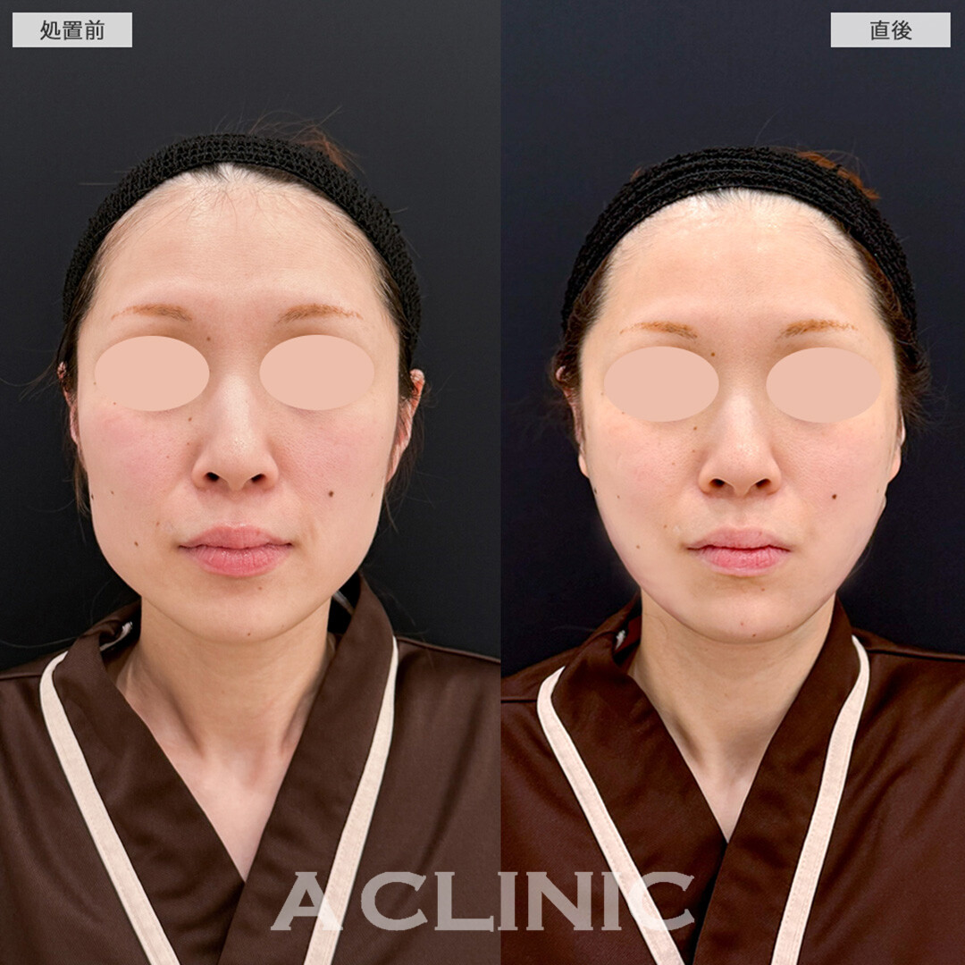1day小顔脂肪吸引と小顔エラボトックスでシャープな輪郭へ！処置前と直後の症例です(30代女性)