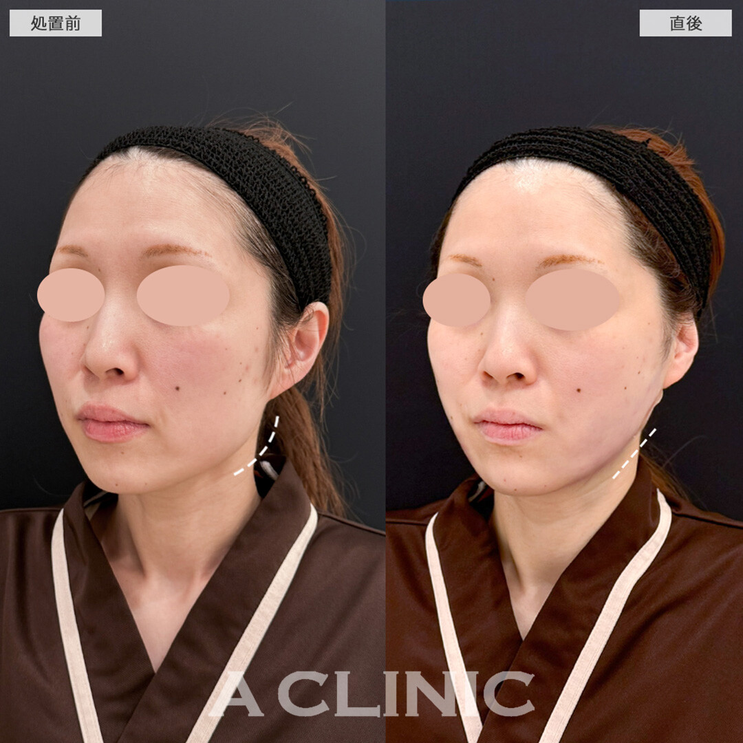 1day小顔脂肪吸引と小顔エラボトックスでシャープな輪郭へ！処置前と直後の症例です(30代女性)