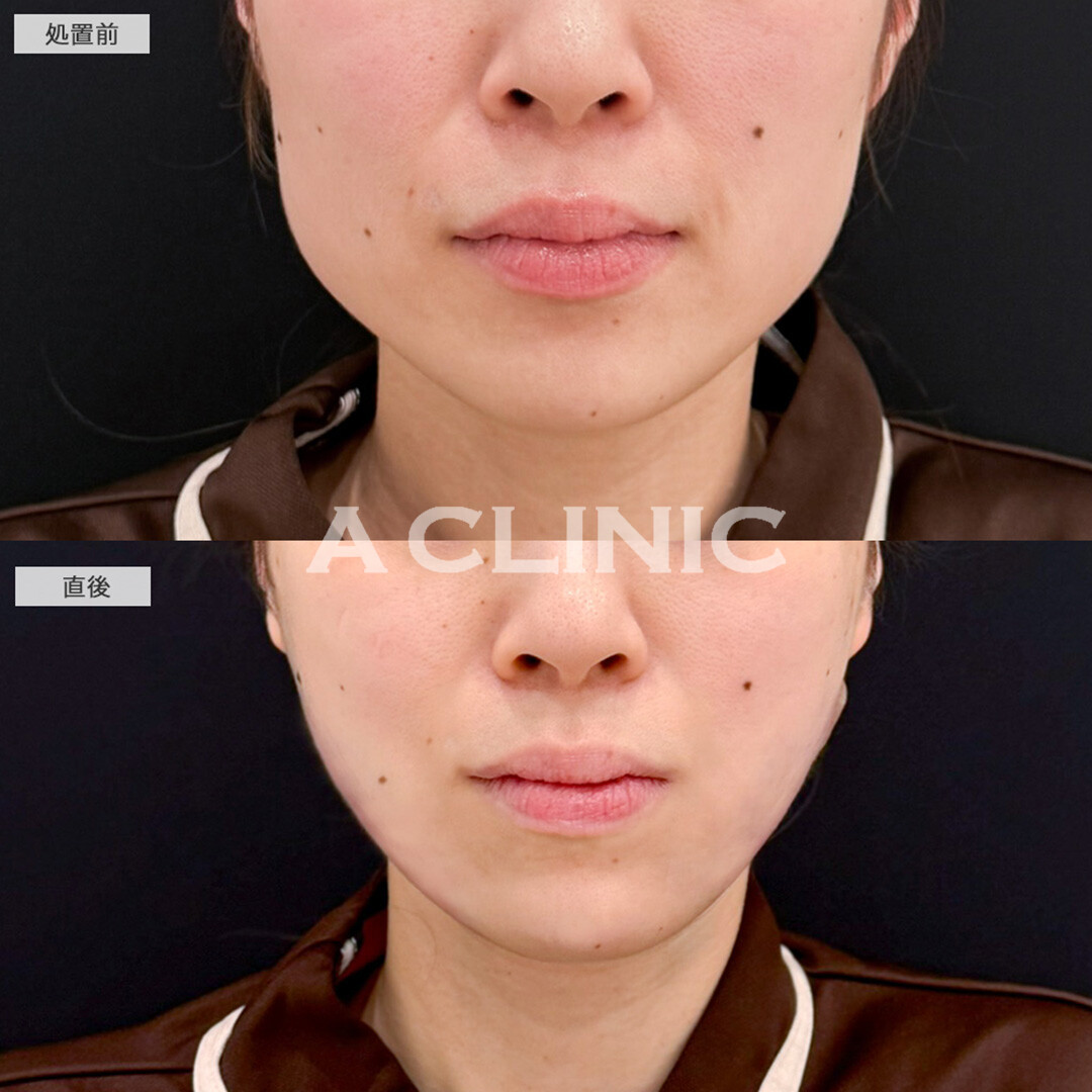 1day小顔脂肪吸引と小顔エラボトックスでシャープな輪郭へ！処置前と直後の症例です(30代女性)