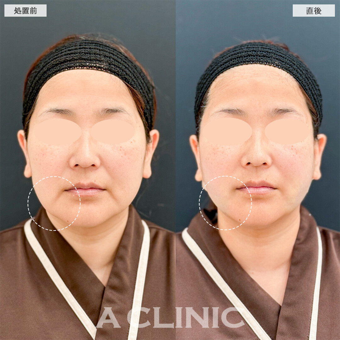 1day小顔脂肪吸引で直後から若返り成功しました！こちら処置前と直後の症例です(40代女性)