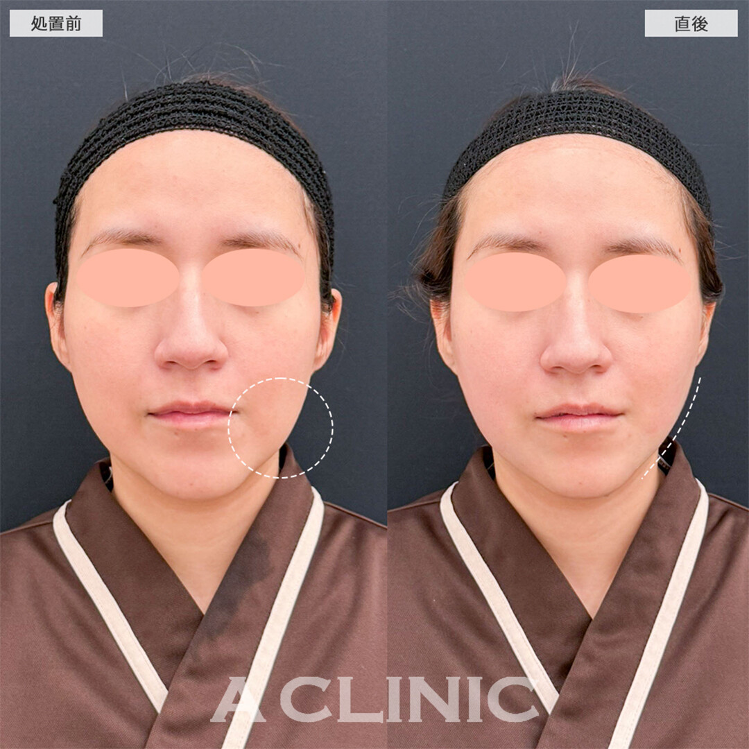 1day小顔脂肪吸引で自然なVフェイスになりました！こちら処置前と直後の症例です(20代女性)