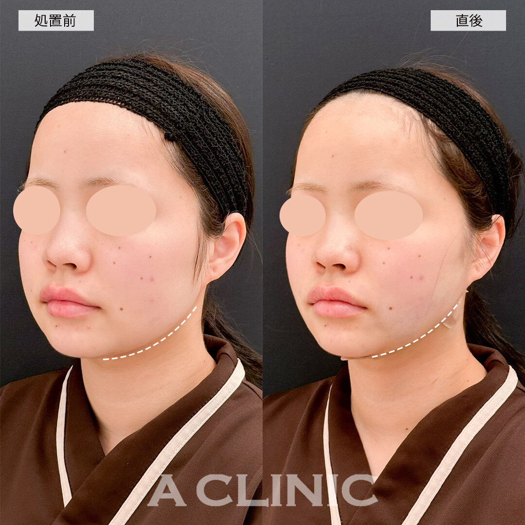 1day小顔脂肪吸引なら直後から腫れ無しで効果を実感できます！処置前と直後の症例です(20代女性)