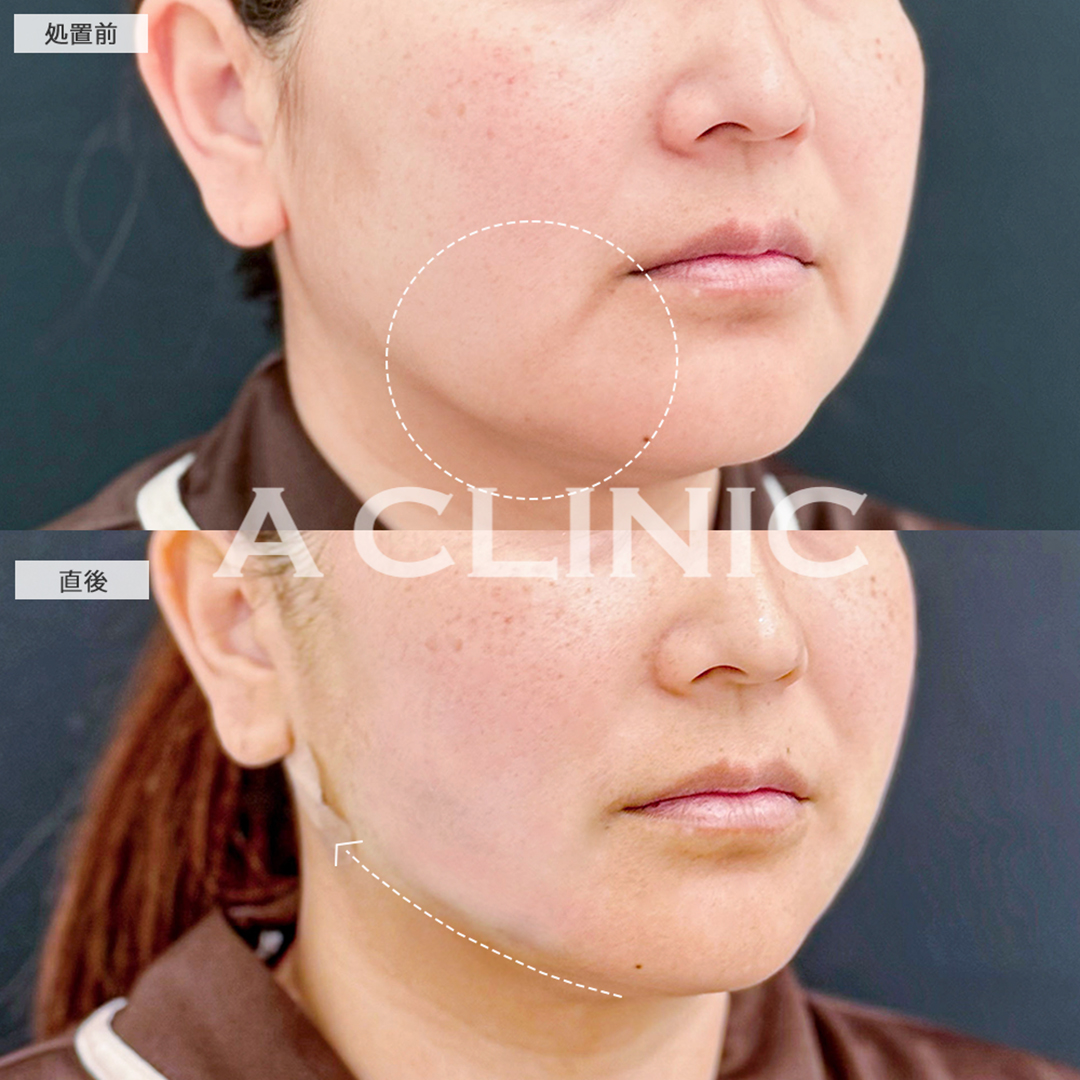 1day小顔脂肪吸引で直後から若返り成功しました！こちら処置前と直後の症例です(40代女性)