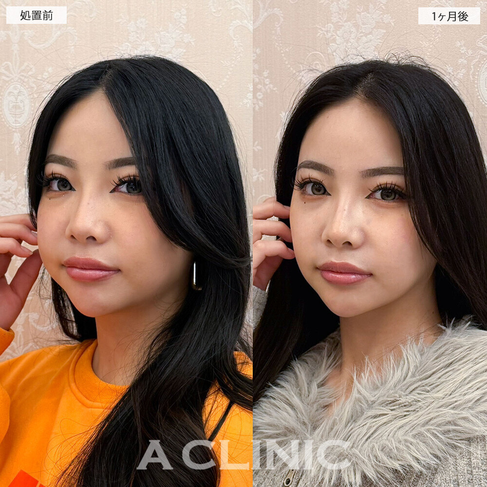 1day小顔脂肪吸引とバッカルファット除去術と小顔エラボトックスで頬のボリューム感改善！こちら処置前と1ヶ月後の症例です(20代女性)