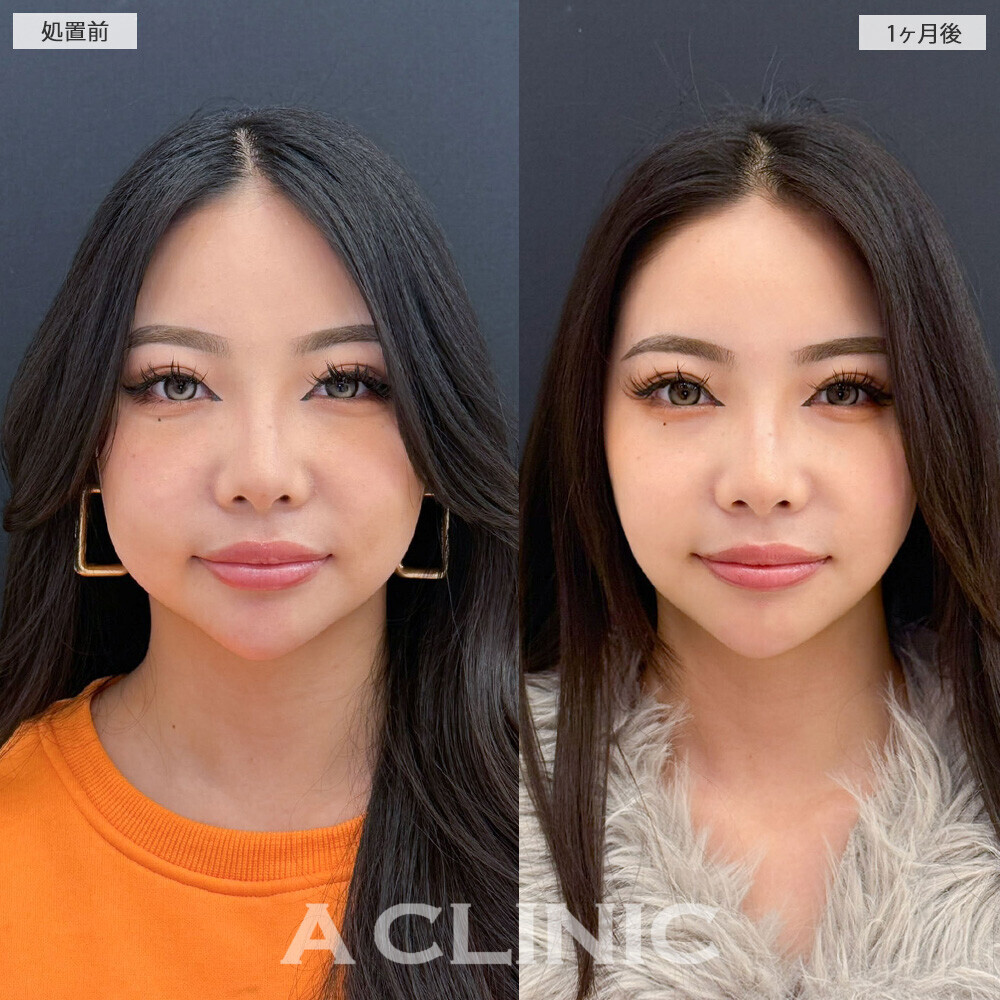 1day小顔脂肪吸引とバッカルファット除去術と小顔エラボトックスで頬のボリューム感改善！こちら処置前と1ヶ月後の症例です(20代女性)