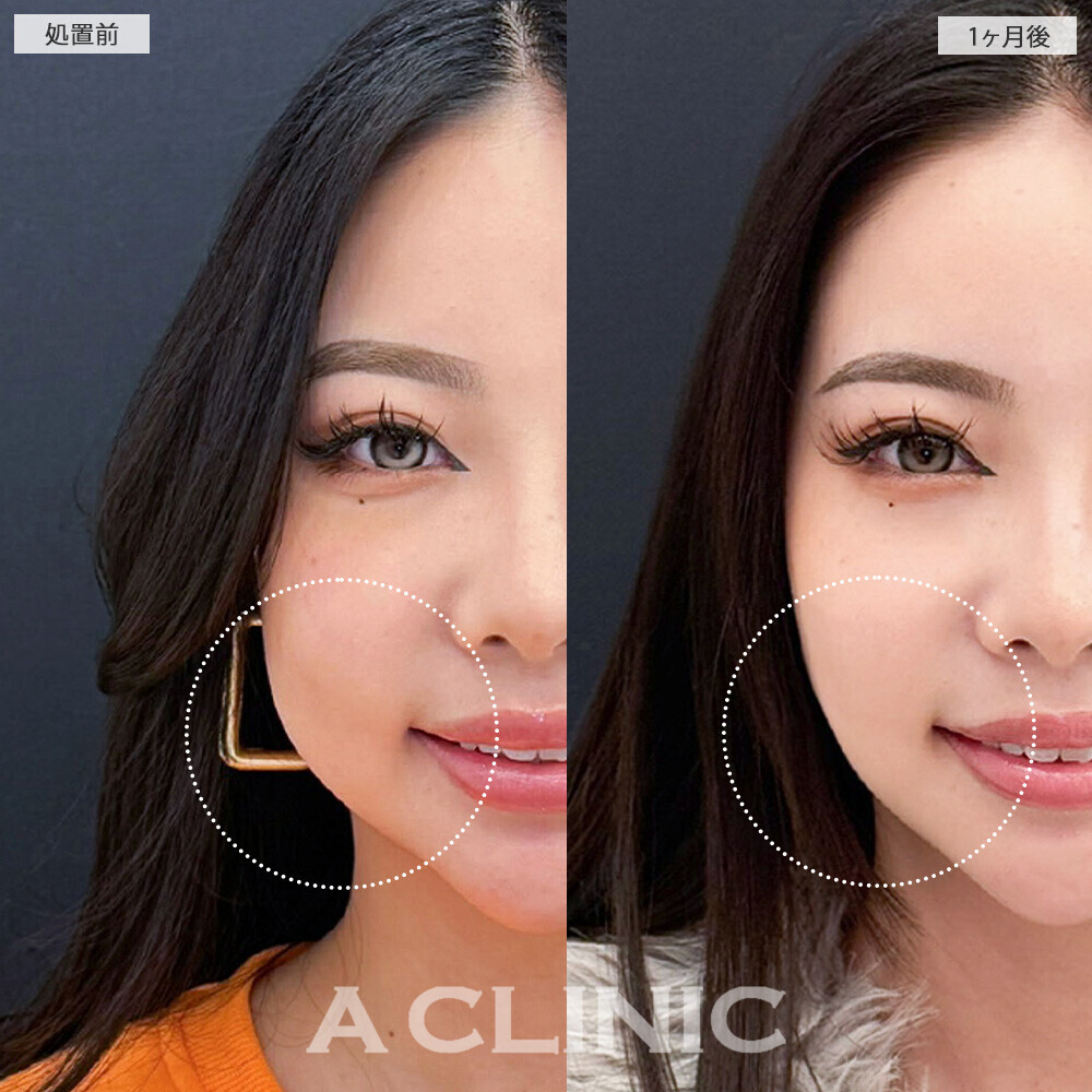 1day小顔脂肪吸引とバッカルファット除去術と小顔エラボトックスで頬のボリューム感改善！こちら処置前と1ヶ月後の症例です(20代女性)