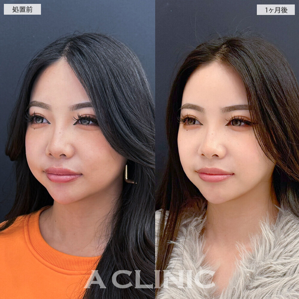 1day小顔脂肪吸引とバッカルファット除去術と小顔エラボトックスで頬のボリューム感改善！こちら処置前と1ヶ月後の症例です(20代女性)