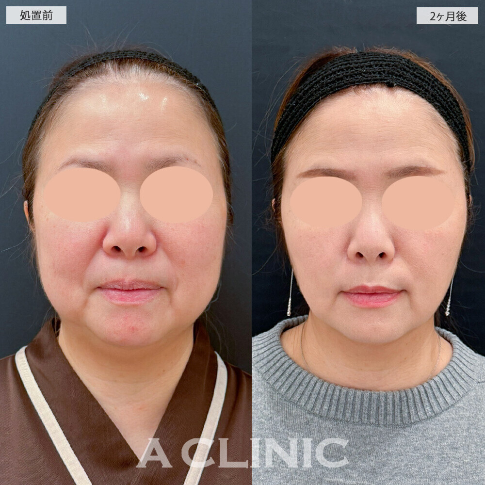 1day小顔脂肪吸引と複合施術で別人級の輪郭に！こちら処置前と2ヶ月後の症例です(40代女性)