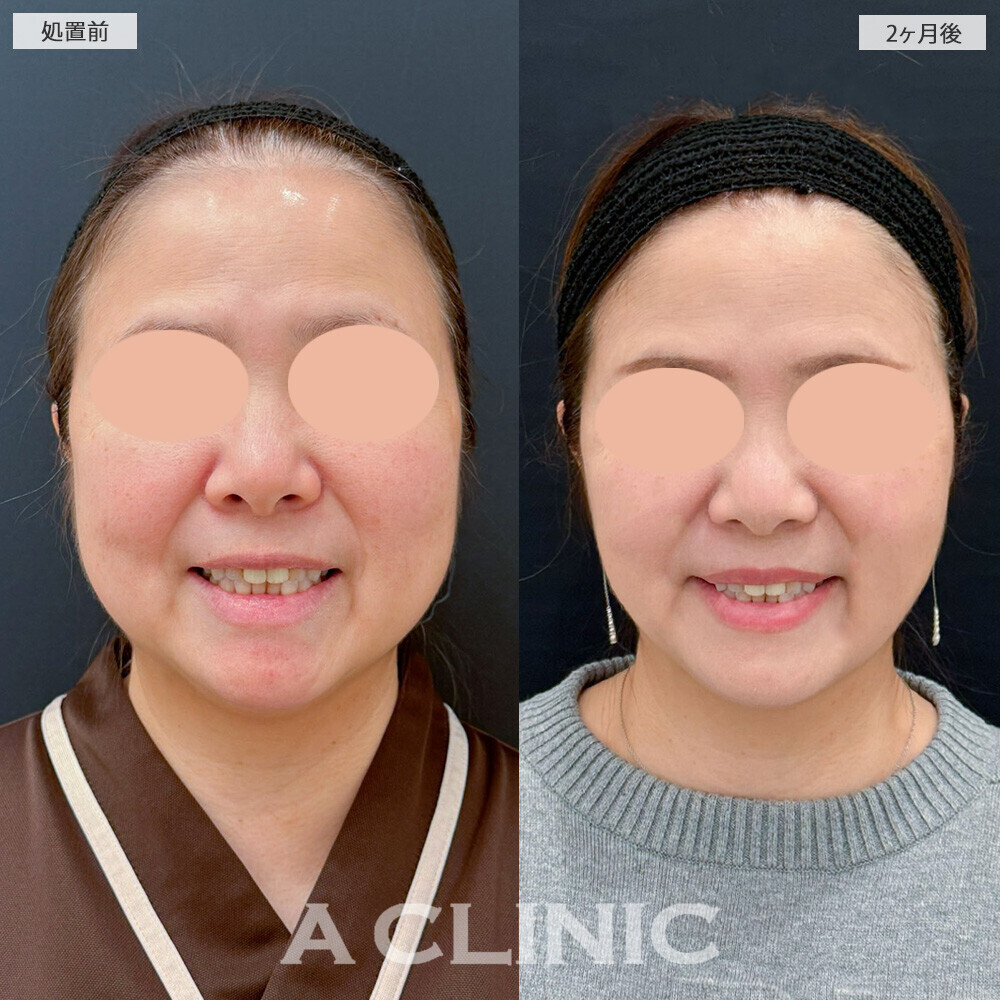 1day小顔脂肪吸引と複合施術で別人級の輪郭に！こちら処置前と2ヶ月後の症例です(40代女性)