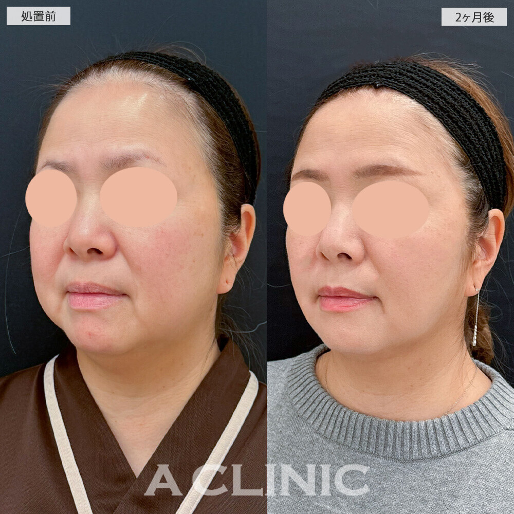 1day小顔脂肪吸引と複合施術で別人級の輪郭に！こちら処置前と2ヶ月後の症例です(40代女性)
