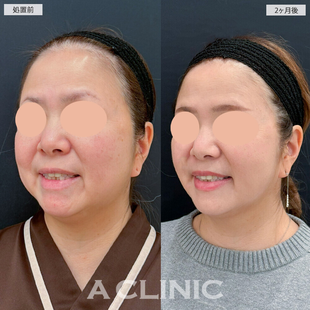 1day小顔脂肪吸引と複合施術で別人級の輪郭に！こちら処置前と2ヶ月後の症例です(40代女性)