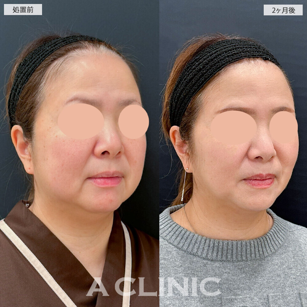 1day小顔脂肪吸引と複合施術で別人級の輪郭に！こちら処置前と2ヶ月後の症例です(40代女性)