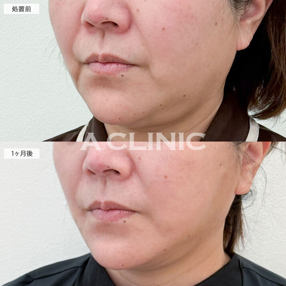 1day小顔脂肪吸引と小顔エラボトックスで口横の脂肪もスッキリ！こちら処置前から2ヶ月後の症例です(50代女性)