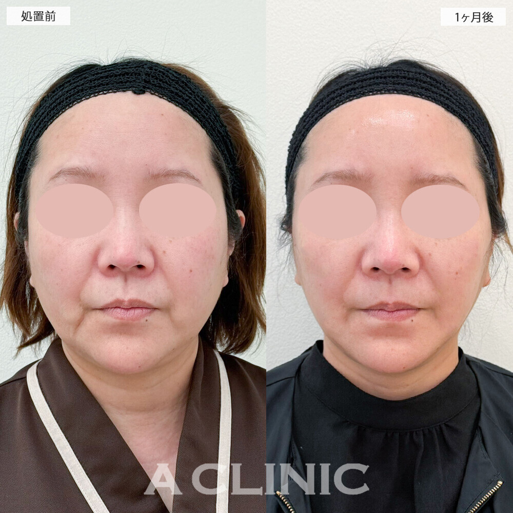 1day小顔脂肪吸引と小顔エラボトックスで口横の脂肪もスッキリ！こちら処置前から2ヶ月後の症例です(50代女性)