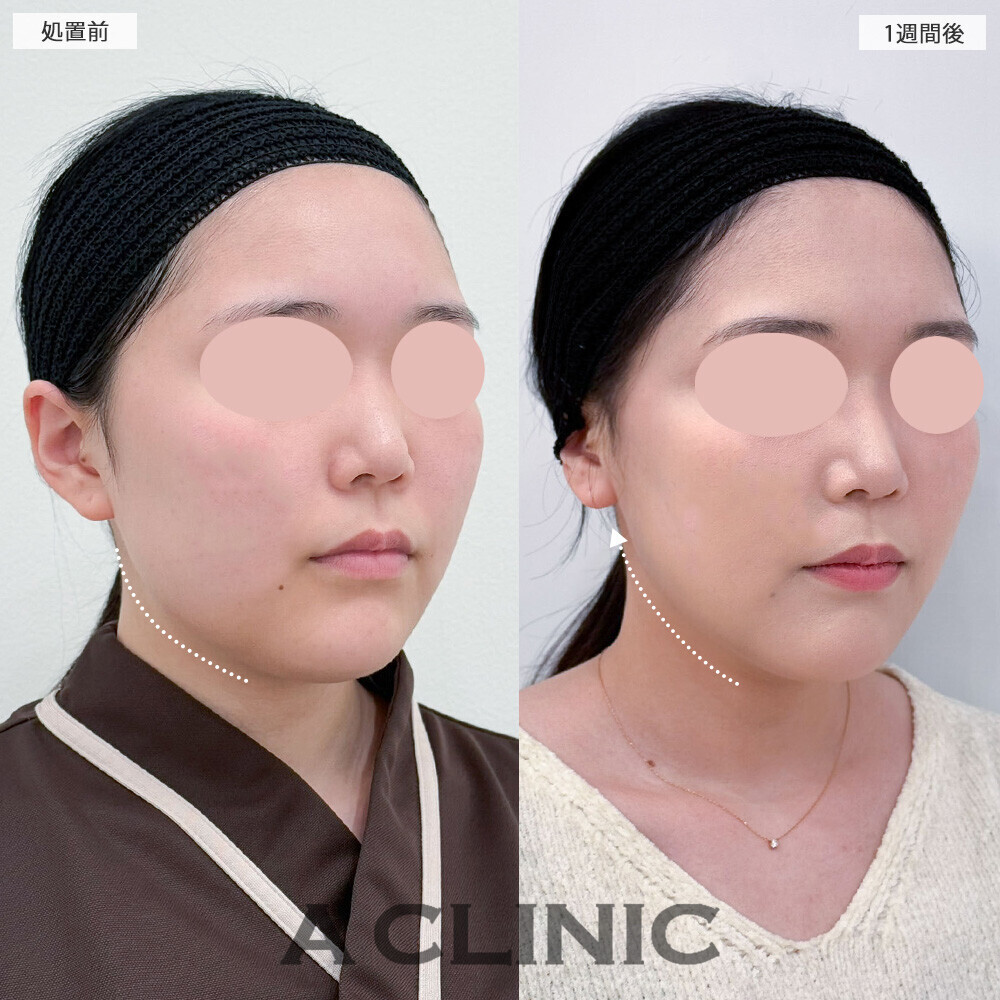 1day小顔脂肪吸引と小顔エラボトックスで下膨れ顔解消！こちら処置前から2ヶ月後の症例です(20代女性)