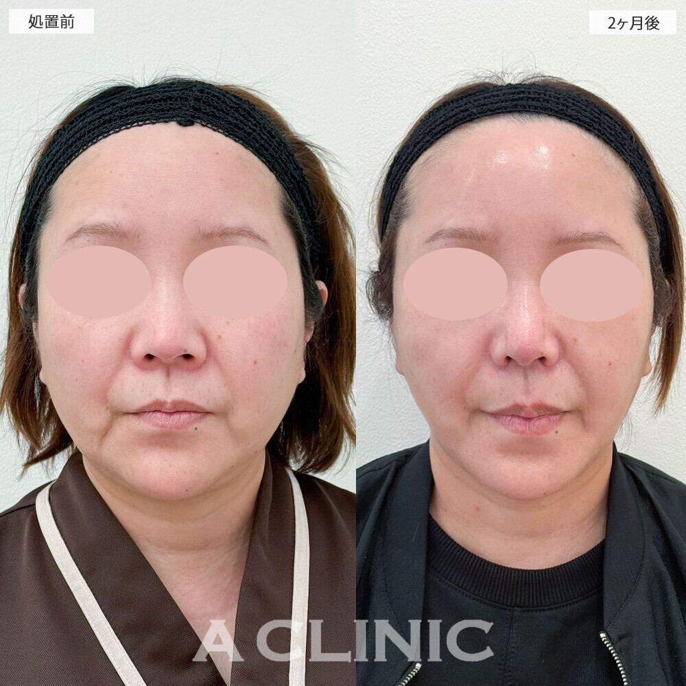 1day小顔脂肪吸引と小顔エラボトックスで口横の脂肪もスッキリ！こちら処置前から2ヶ月後の症例です(50代女性)