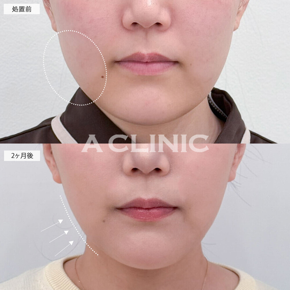 1day小顔脂肪吸引と小顔エラボトックスで下膨れ顔解消！こちら処置前から2ヶ月後の症例です(20代女性)