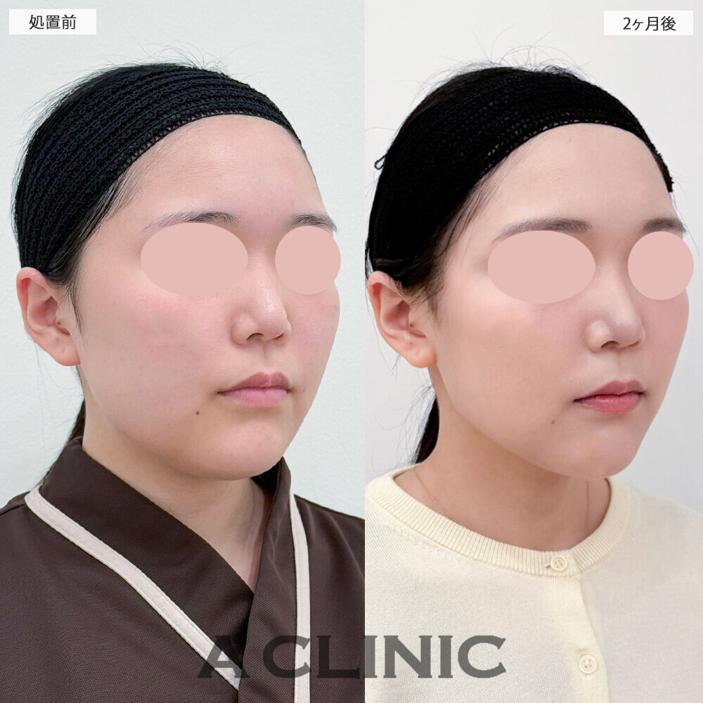 1day小顔脂肪吸引と小顔エラボトックスで下膨れ顔解消！こちら処置前から2ヶ月後の症例です(20代女性)