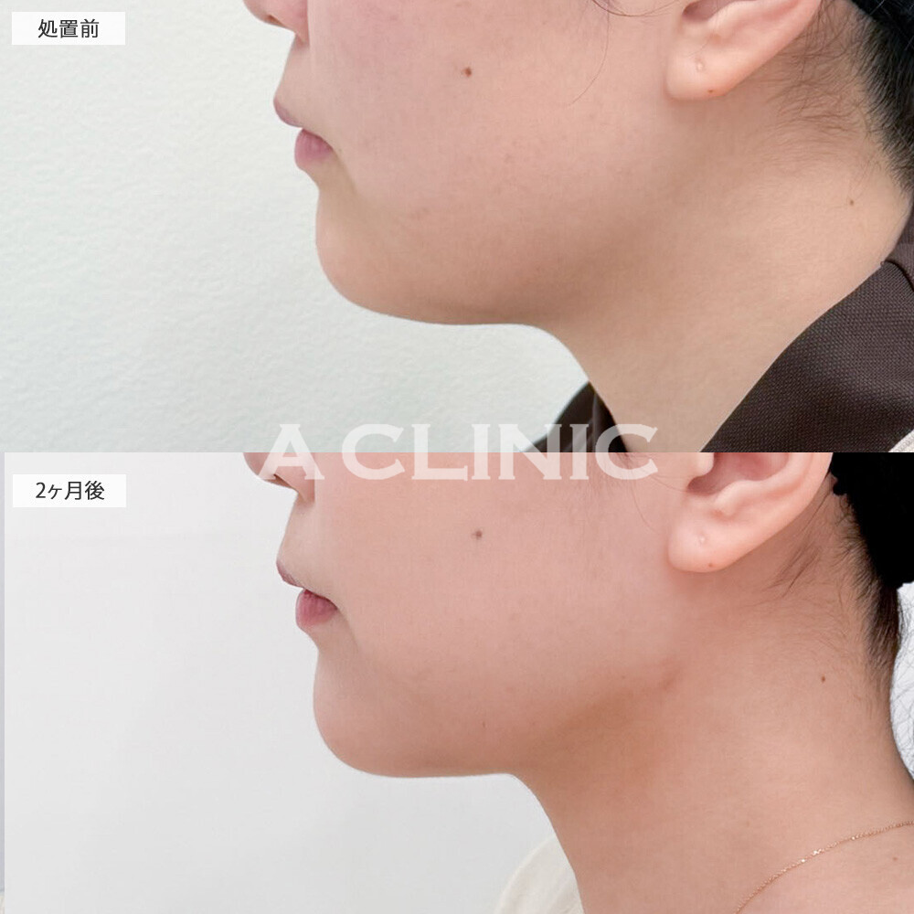 1day小顔脂肪吸引と小顔エラボトックスで下膨れ顔解消！こちら処置前から2ヶ月後の症例です(20代女性)