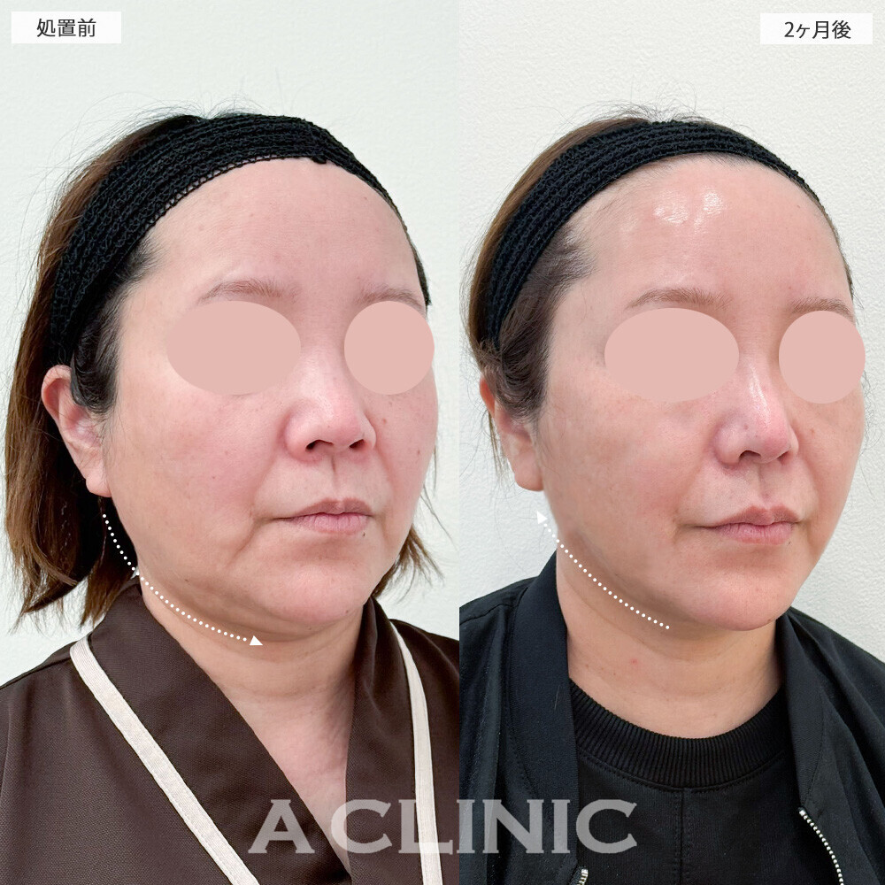 1day小顔脂肪吸引と小顔エラボトックスで口横の脂肪もスッキリ！こちら処置前から2ヶ月後の症例です(50代女性)