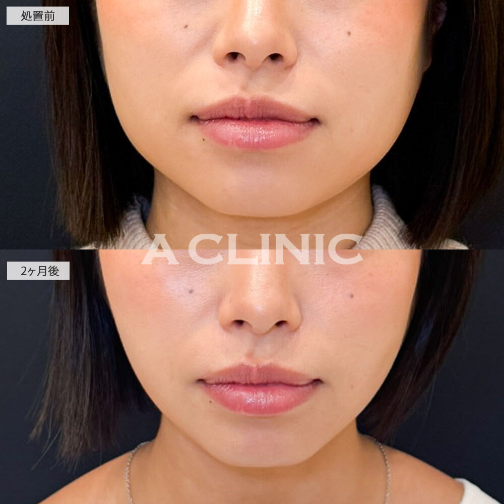 Aスレッドと小顔エラボトックスで手軽に小顔に！こちら処置前と2ヶ月後の症例です(20代女性)