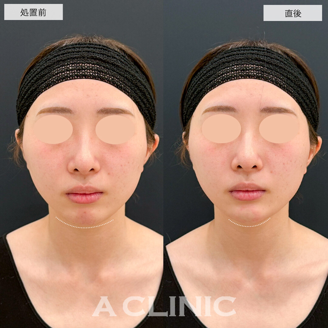 あごへのヒアルロン酸注入でEラインが整い輪郭も綺麗になりました!こちら処置前と直後の症例です(20代女性)