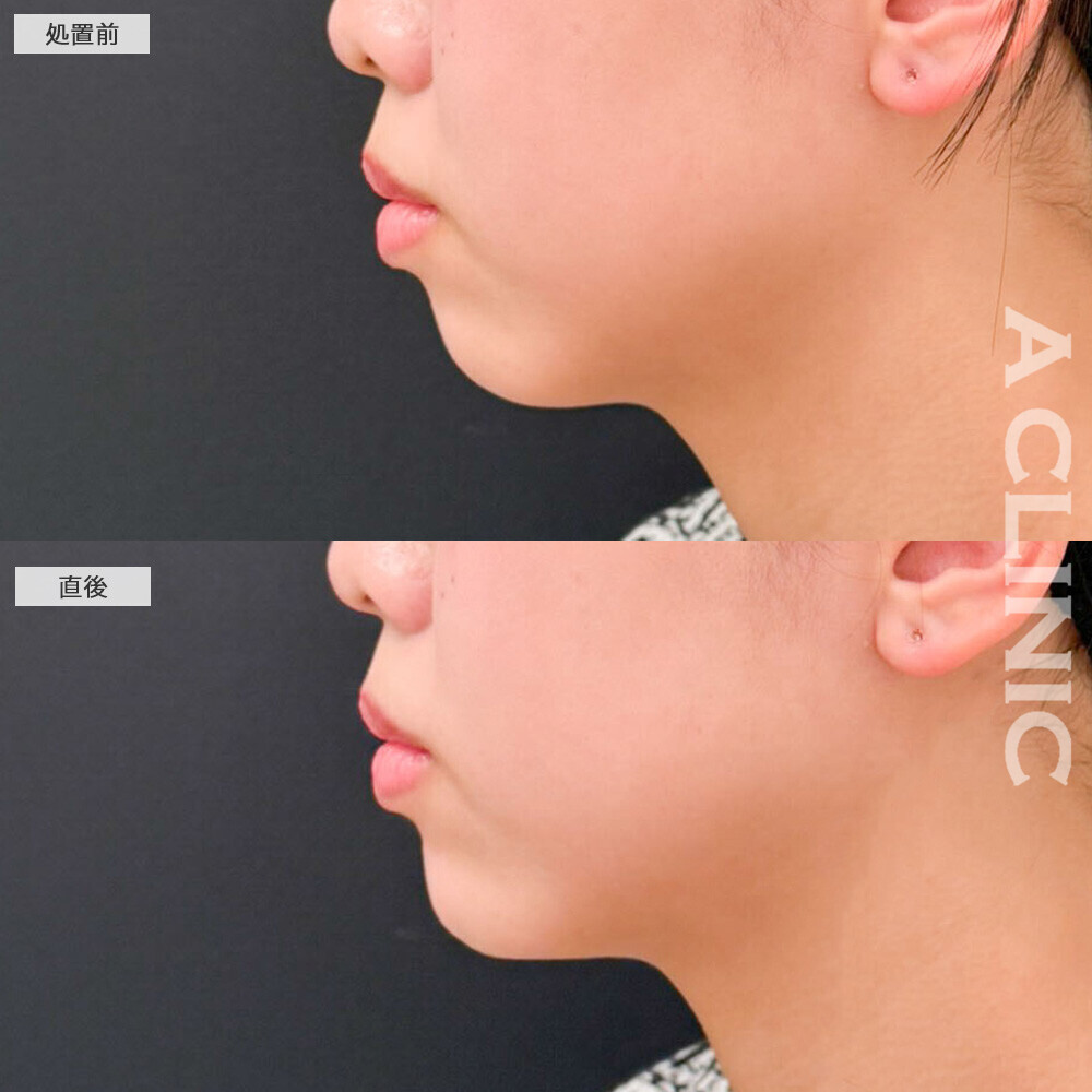 あごのヒアルロン酸注射でEラインが整いました！こちら処置前と直後の症例です(20代女性)