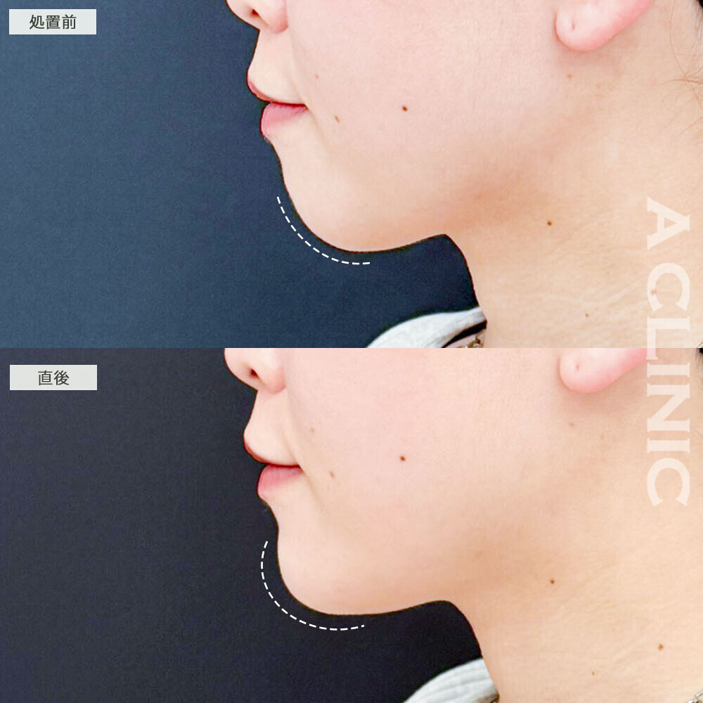 あごのヒアルロン酸注射で口ゴボが改善し垢抜けた印象に！こちら処置前と直後の症例です(30代女性)