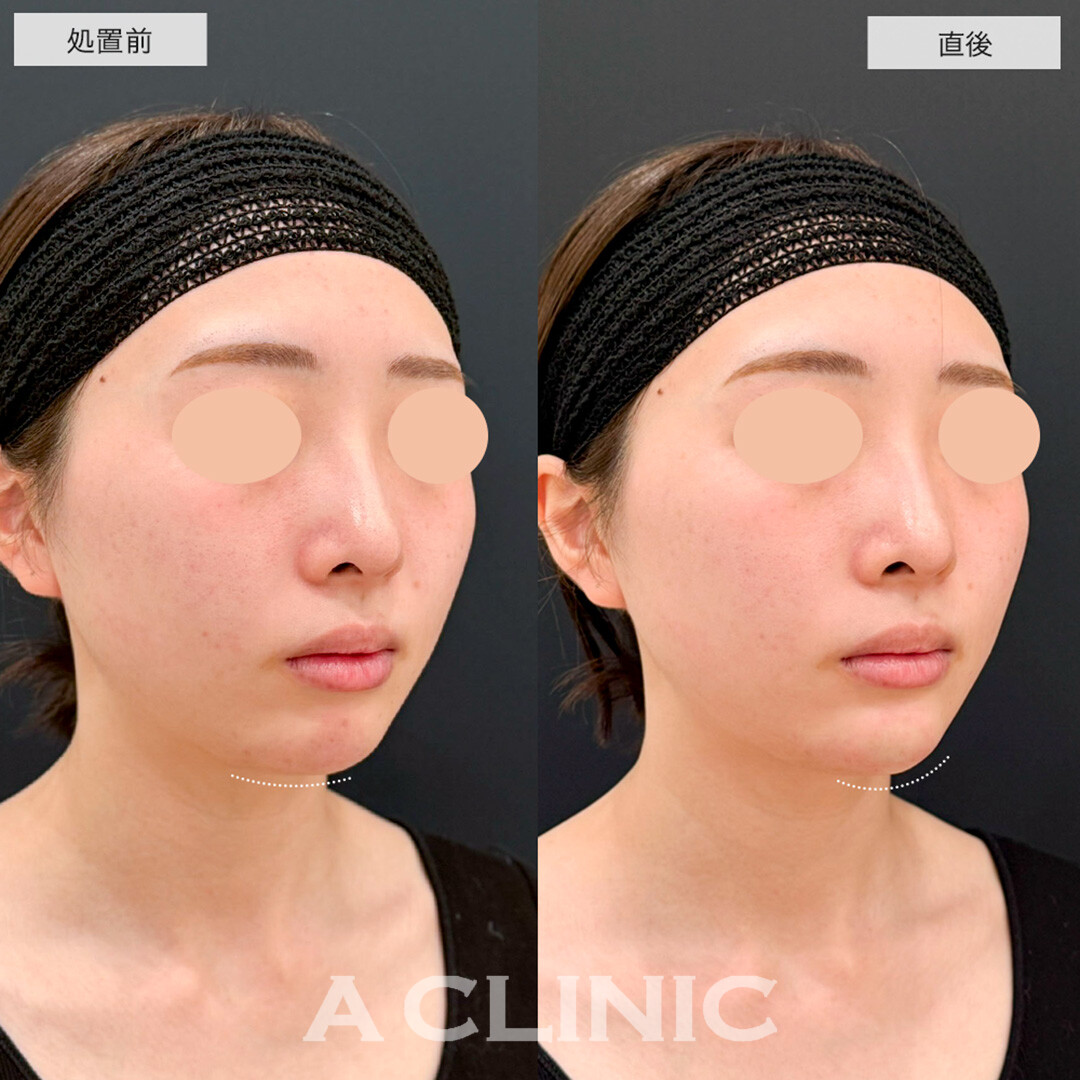あごへのヒアルロン酸注入でEラインが整い輪郭も綺麗になりました!こちら処置前と直後の症例です(20代女性)