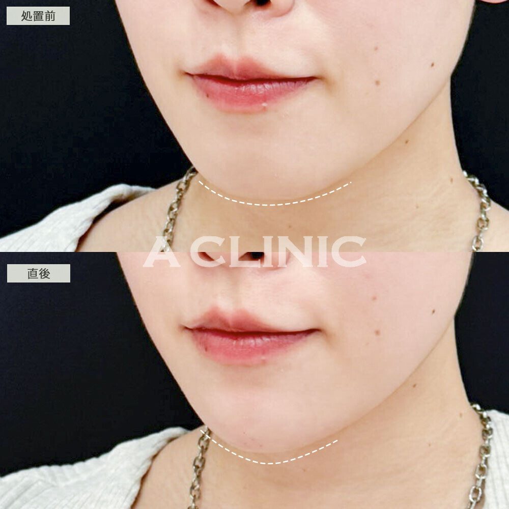 あごのヒアルロン酸注射で口ゴボが改善し垢抜けた印象に！こちら処置前と直後の症例です(30代女性)