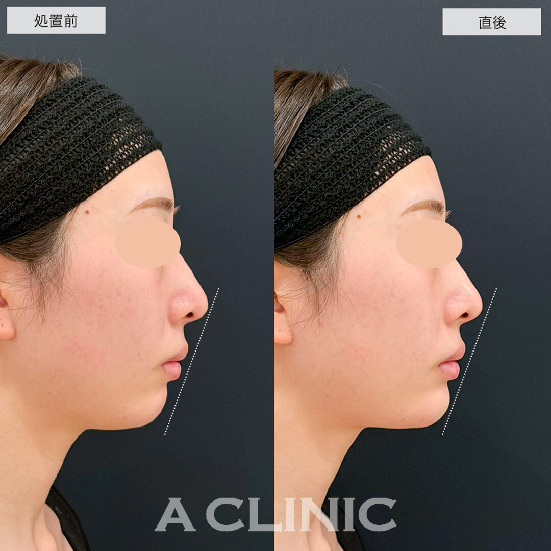 あごへのヒアルロン酸注入でEラインが整い輪郭も綺麗になりました!こちら処置前と直後の症例です(20代女性)
