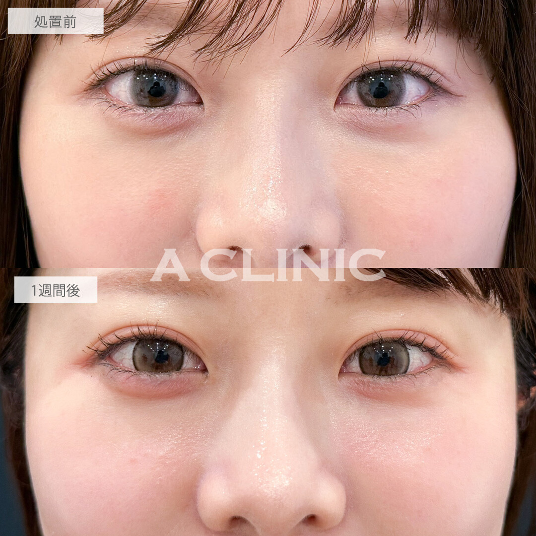 A式コンシーラー注射で目の下の凹みと色味を改善できました！こちら処置前と1週間後の症例です(20代女性)