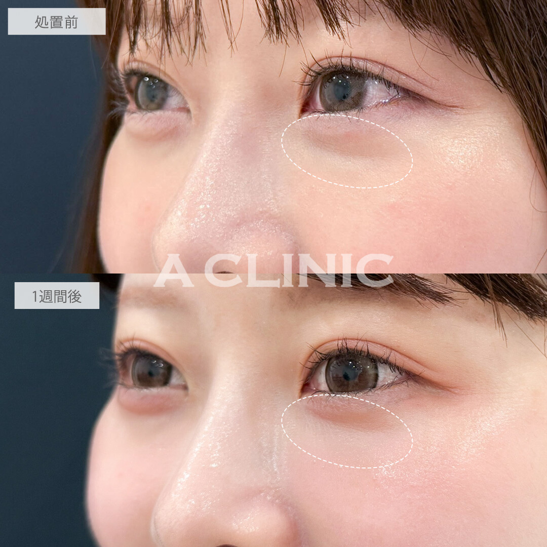 A式コンシーラー注射で目の下の凹みと色味を改善できました！こちら処置前と1週間後の症例です(20代女性)