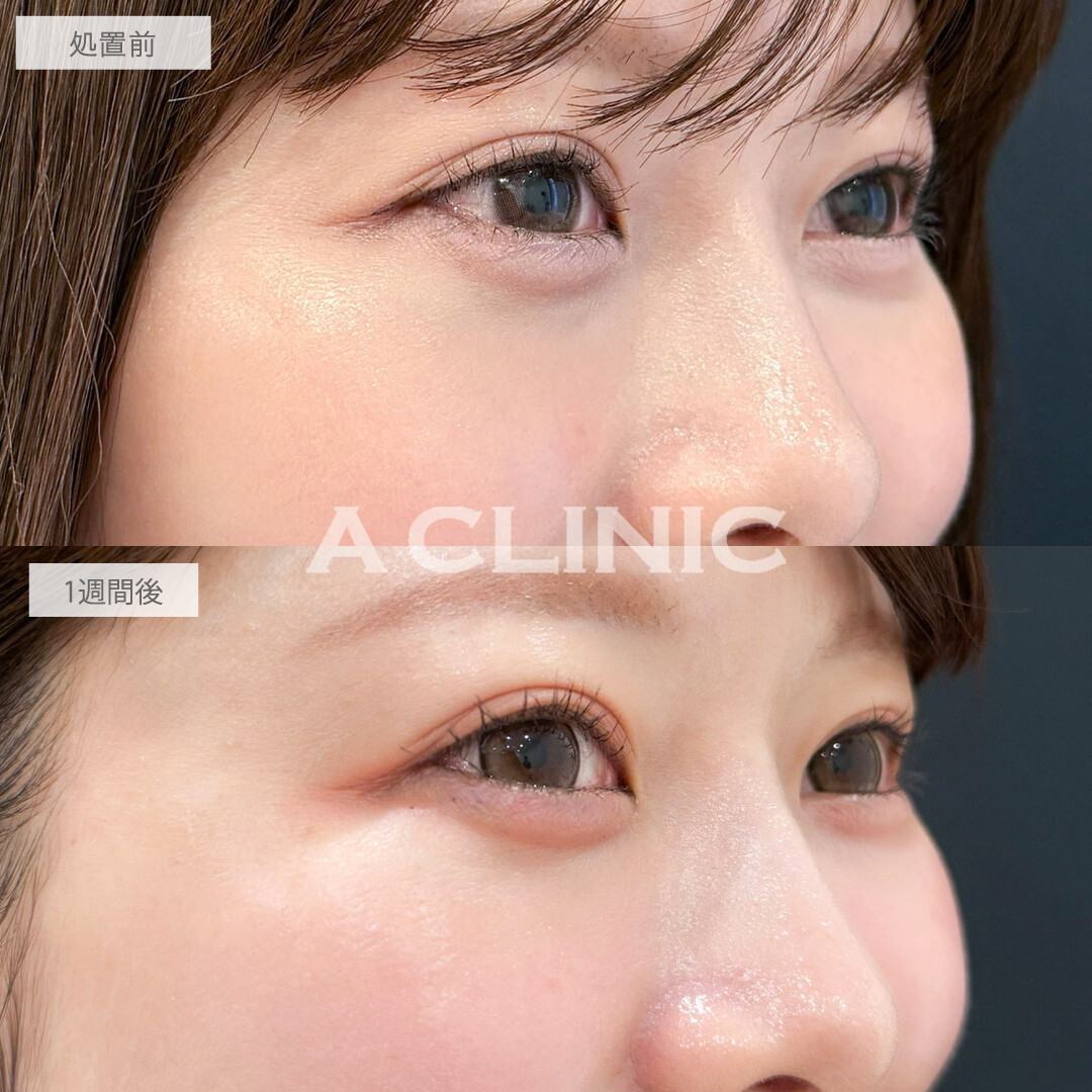 A式コンシーラー注射で目の下の凹みと色味を改善できました！こちら処置前と1週間後の症例です(20代女性)