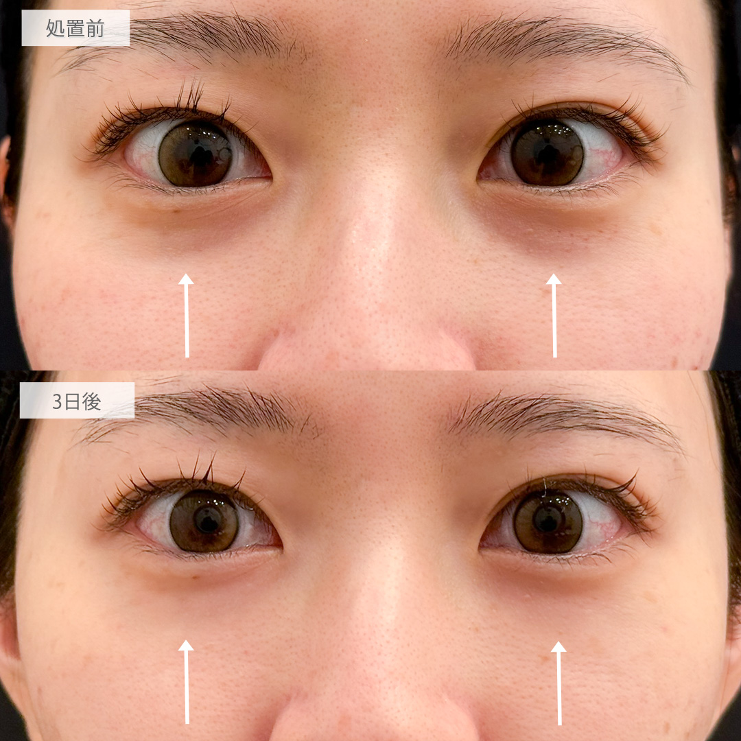 A式コンシーラー注射でクマを軽減し疲れ顔と老け顔を改善！処置前と3日後の症例です(20代女性)